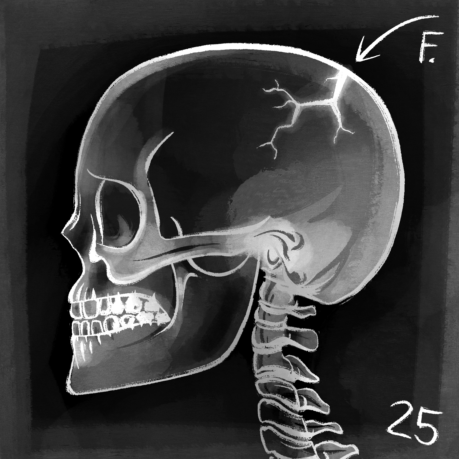 A black and white drawing of an x-ray of a skull with a giant crack on the top/back. The skull is facing to the left and you can see the neck vertebrae below it. It is drawn in white over a black background with white shading here and there to make it look like an x-ray. It is not anatomically correct, and the skull appears to be grimacing, with downturned mouth and worried eye sockets. On the upper right at the top/back of the head is a fracture with many branches coming off of it. The background fades a little at the edges and there is an arrow drawn on top pointing to the crack and labelling it with "F.". At the bottom right, the number "25" has been written on the corner.